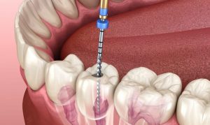 The Impact of Technology on Root Canal Comfort: Modern Advancements in Endodontics in Bethesda, MD
